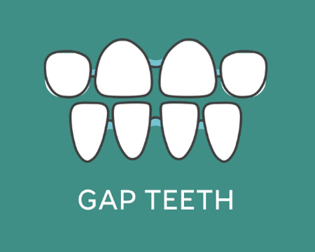 Gap-Teeth